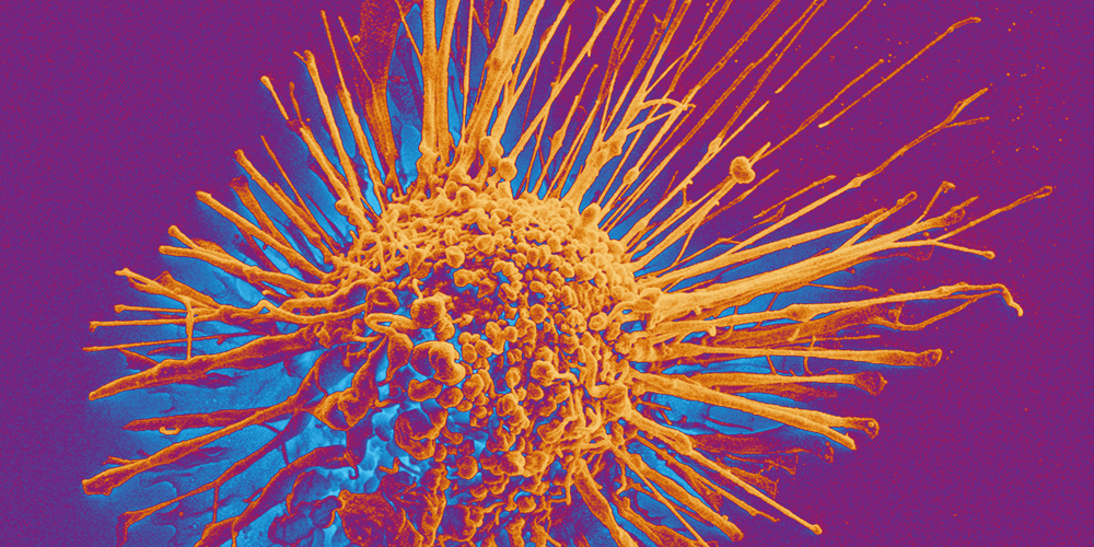 Scanning electron microscopy image of a cancer cell. (Image: University of Basel, Swiss Nanoscience Institute/Biozentrum) Scanning electron microscopy image of a cancer cell. (Image: University of Basel, Swiss Nanoscience Institute/Biozentrum)