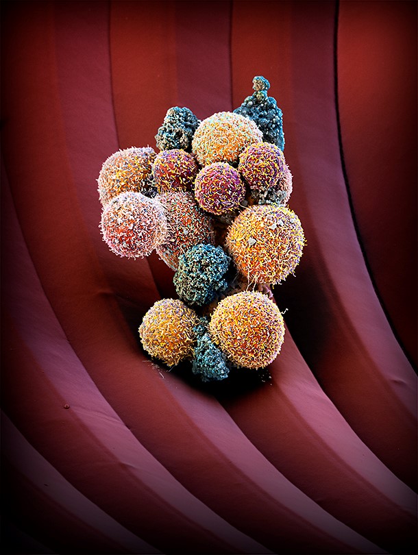 The image represents an artistic coloration of a cluster of circulating tumor cells (CTCs), isolated from the blood of a patient with breast cancer, trapped on a microfluidic device. The image represents an artistic coloration of a cluster of circulating tumor cells (CTCs), isolated from the blood of a patient with breast cancer, trapped on a microfluidic device.