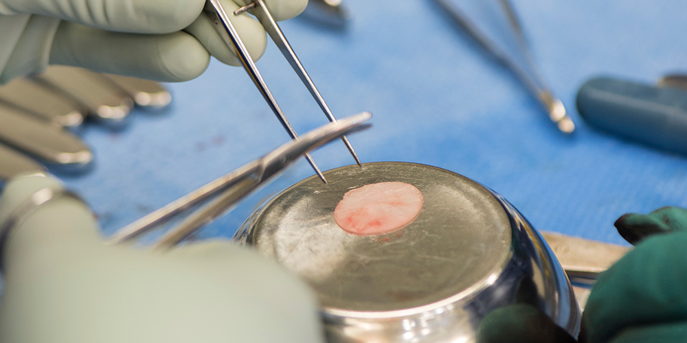 Engineered cartilage from nasal septum cells helps treat complex knee injuries