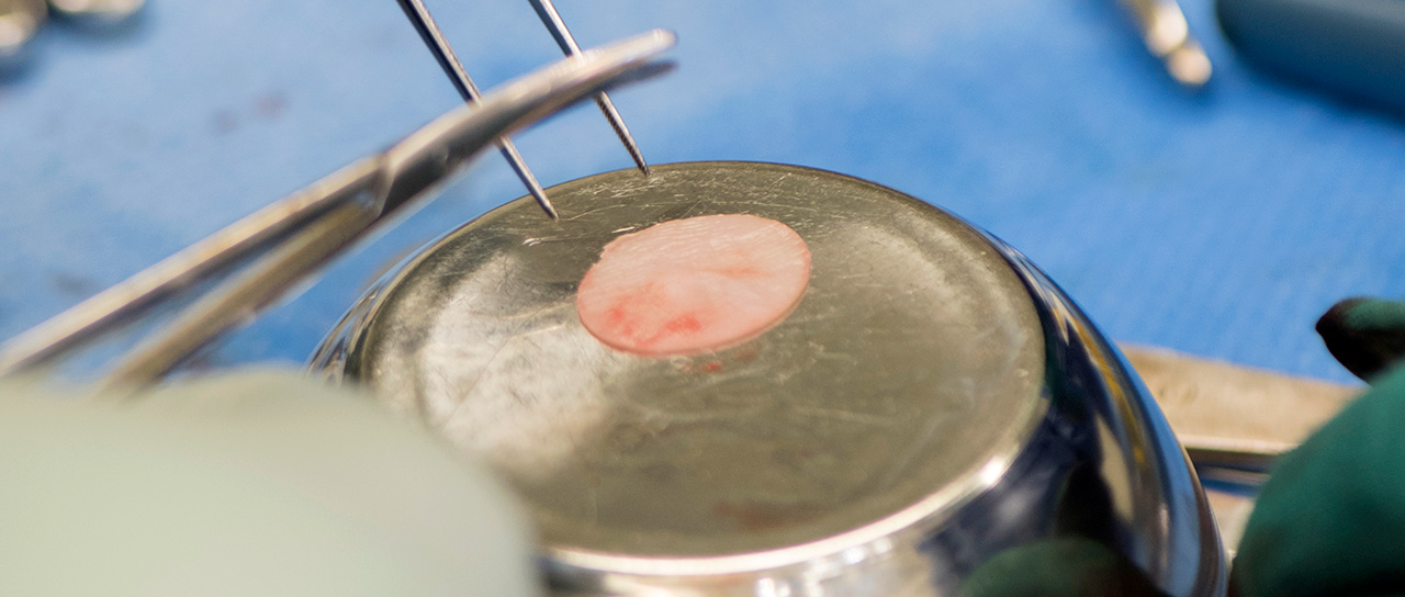 A piece of new cartilage grown from cells of the nasal septum.